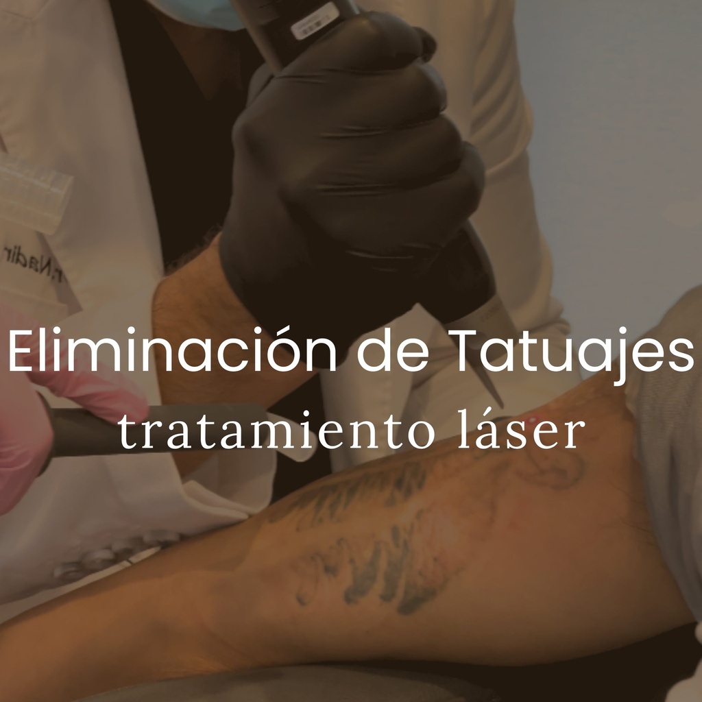 Academia Qazi - Eliminación de Tatuajes - Pequeño (Hasta 3 pulgadas cuadradas)