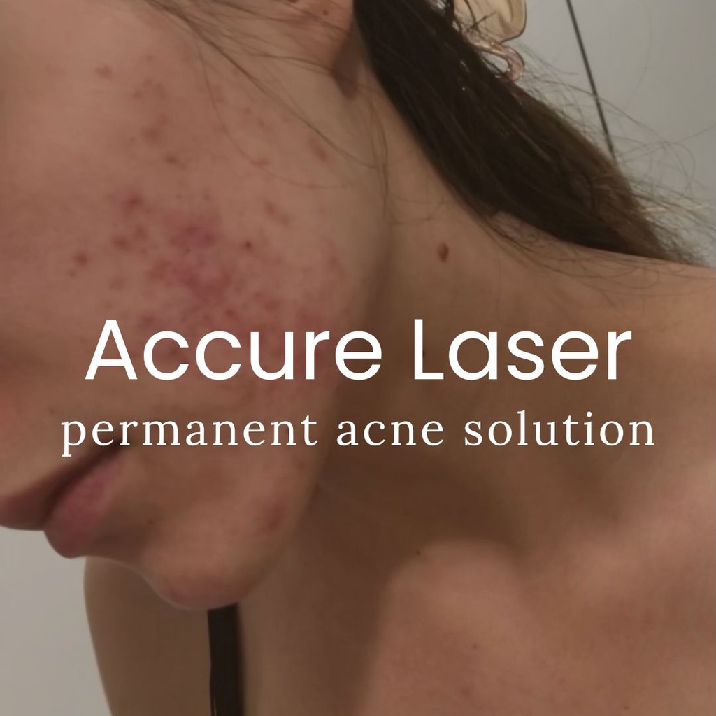 Accure Acne Treatment - Buttocks