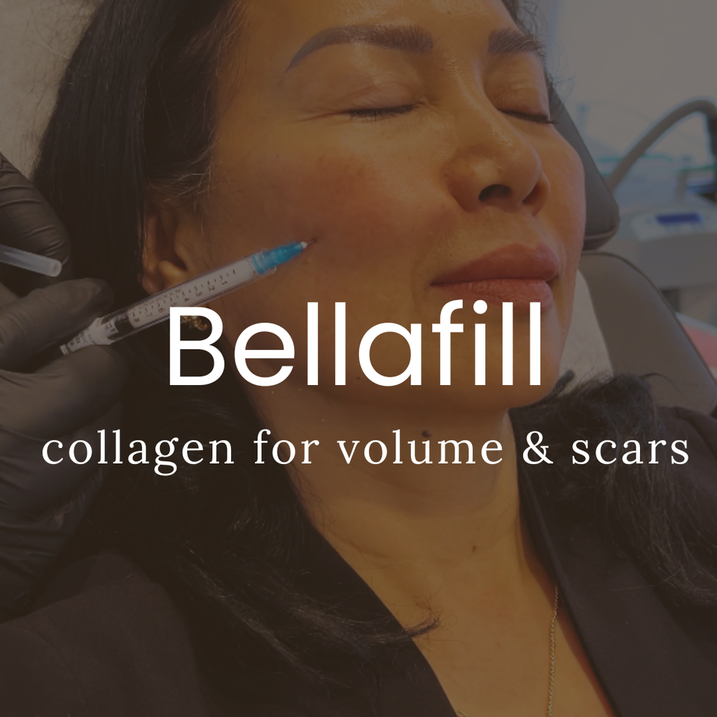 Bellafill Collagen Filler - Regular Pricing