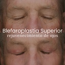 Blefaroplastia Superior