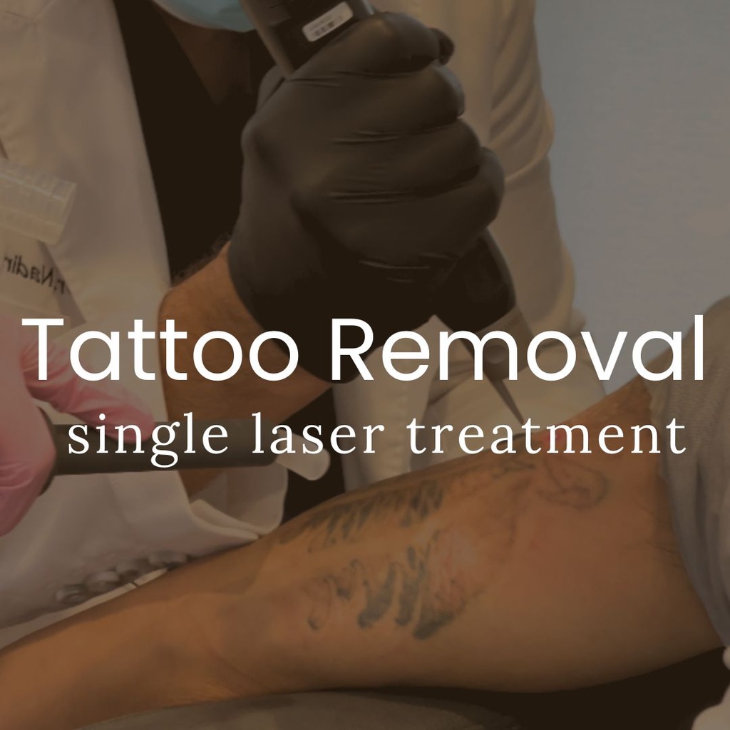 Laser Tattoo Removal - Small ( Up to 3 Square Inches)