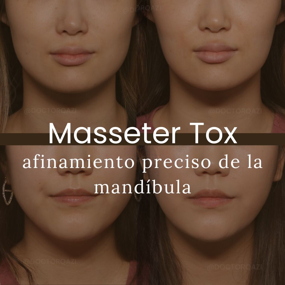 Masseter Tox