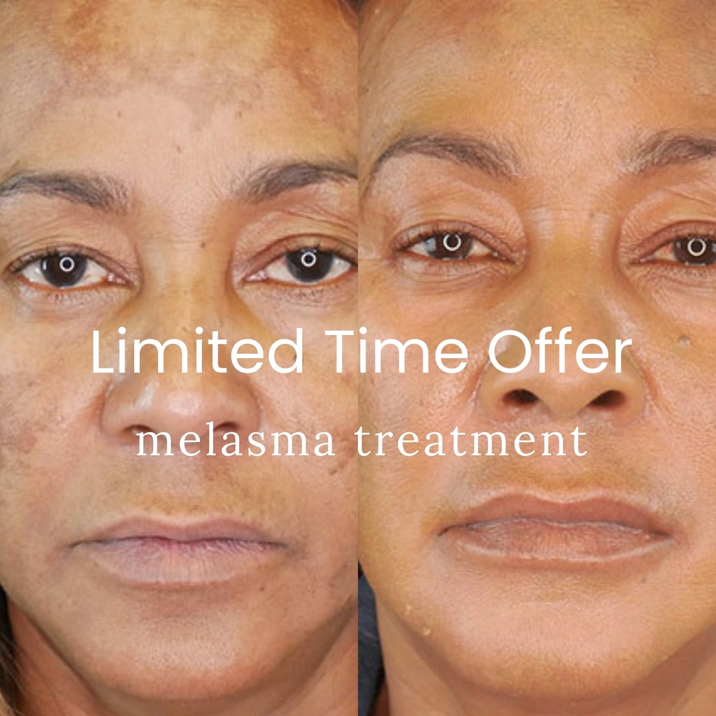 MELASMA TREATMENT - PICO LASER