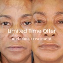 MELASMA TREATMENT - PICO LASER