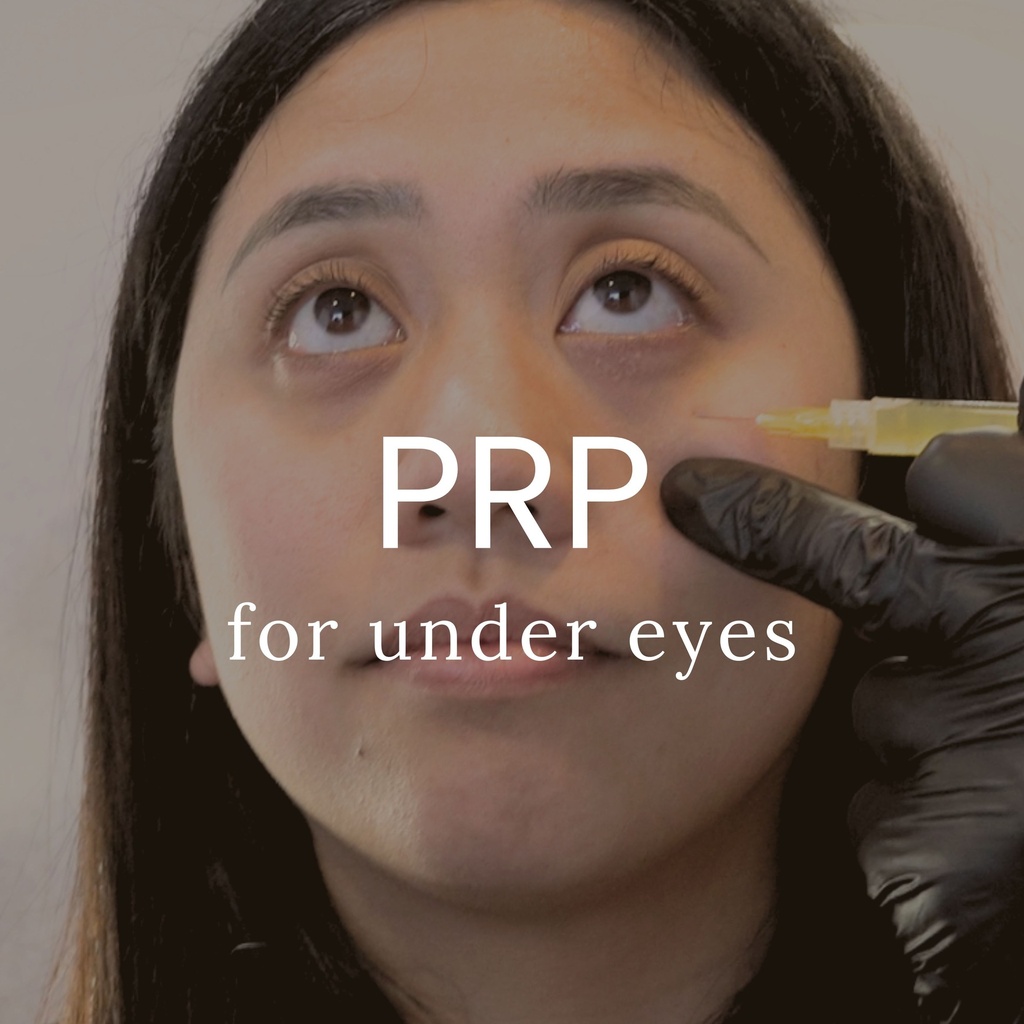 PRP Treatment for Undereyes - One Session