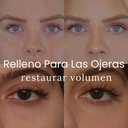 Relleno para las Ojeras
