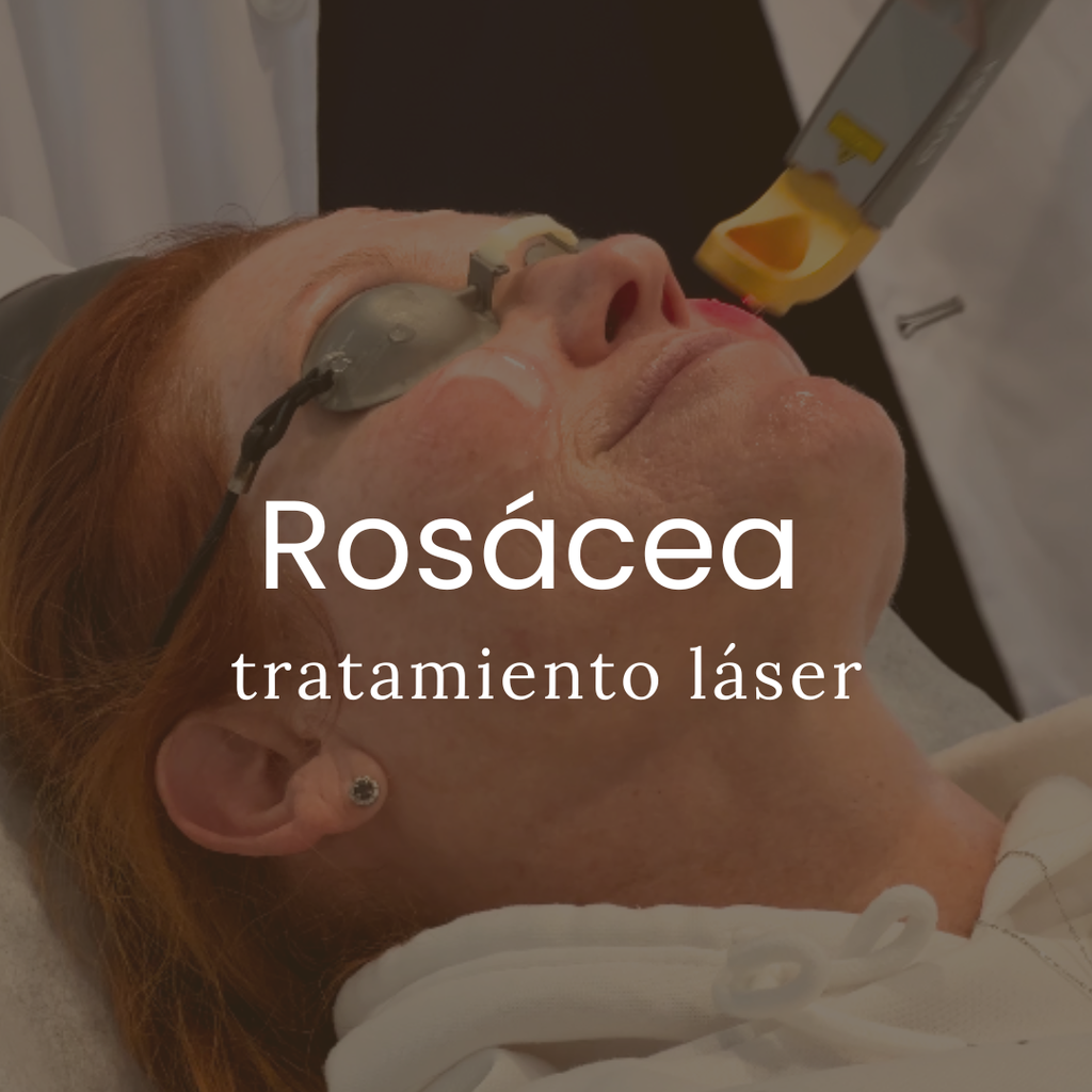 Tratamiento Láser Para Rosácea