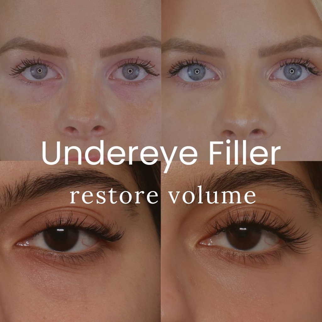 Undereye Filler - Crystal Pricing