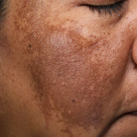Discoloration & Melasma