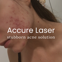 Accure Acne Laser Treatment