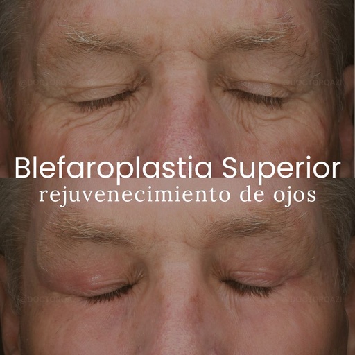 Blefaroplastia Superior