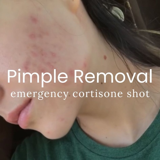 Emergency Pimple Removal 20% OFF