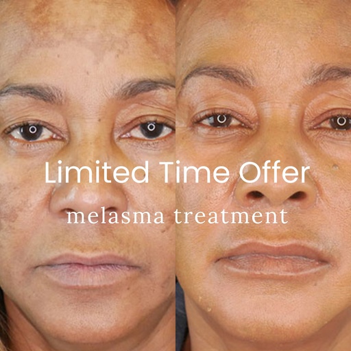 MELASMA TREATMENT - Black Label MD Peel