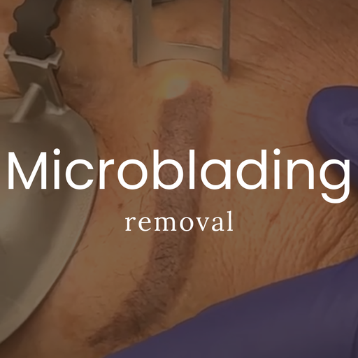 Microblading Removal - One Session (Qazi Academy)