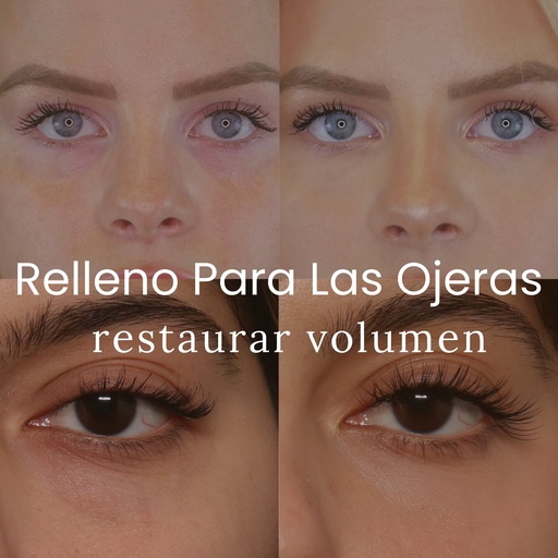 Relleno para las Ojeras