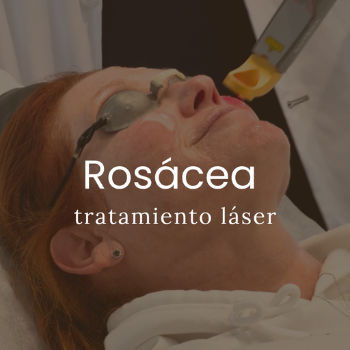 Tratamiento Láser Para Rosácea