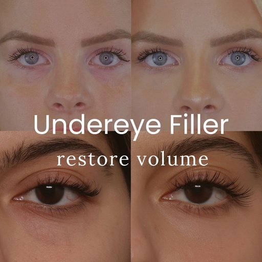 Undereye Filler - Regular Pricing